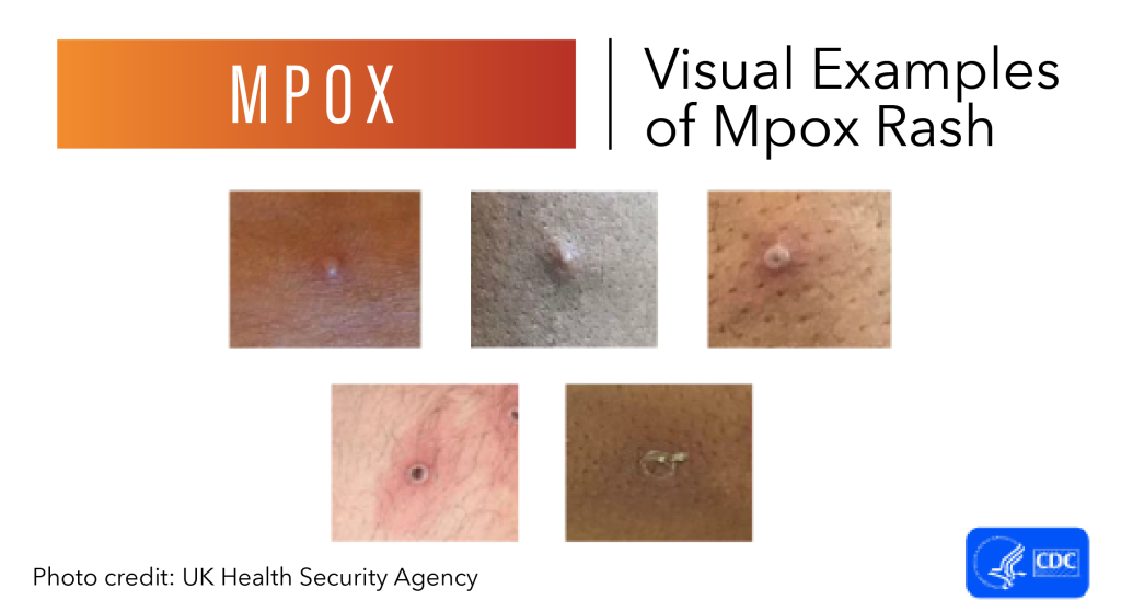 mpox website image v2-01 1