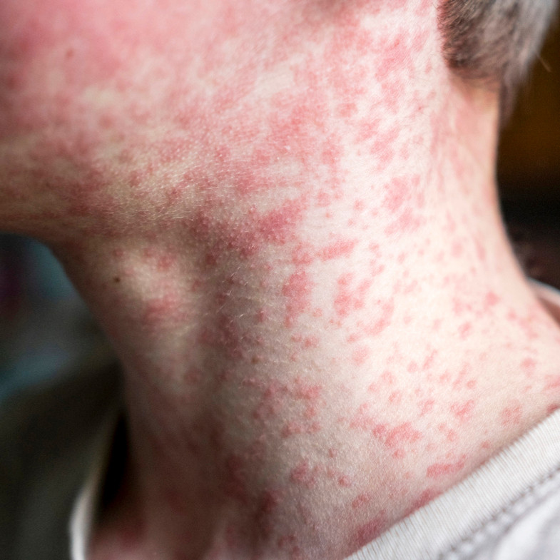 Health - Web_aph-measles